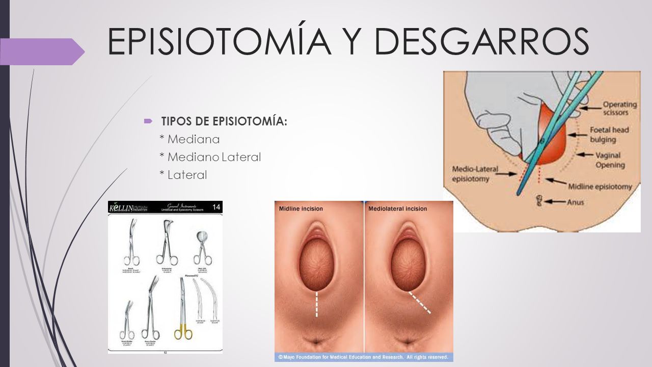 fotos de episiotomia reales